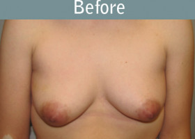 Milwaukee Plastic Surgery - Breast Reconstruction - Direct to Implant - 10-1