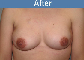 Milwaukee Plastic Surgery - Breast Reconstruction - Direct to Implant - 10-2