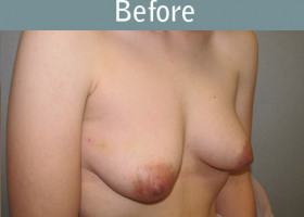 Milwaukee Plastic Surgery - Breast Reconstruction - Direct to Implant - 10-3