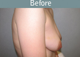 Milwaukee Plastic Surgery - Breast Reconstruction - Direct to Implant - 10-5