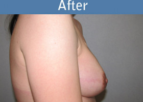 Milwaukee Plastic Surgery - Breast Reconstruction - Direct to Implant - 10-6