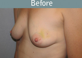 Milwaukee Plastic Surgery - Breast Reconstruction - Direct to Implant - 2-1