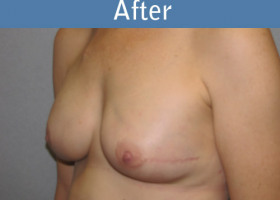 Milwaukee Plastic Surgery - Breast Reconstruction - Direct to Implant - 2-2