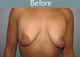 Milwaukee Plastic Surgery - Breast Reconstruction - Direct to Implant - 11-1