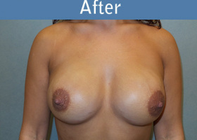 Milwaukee Plastic Surgery - Breast Reconstruction - Direct to Implant - 11-2