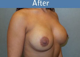 Milwaukee Plastic Surgery - Breast Reconstruction - Direct to Implant - 11-4