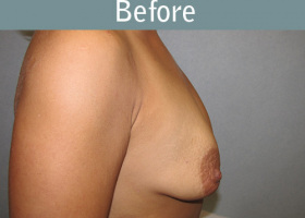 Milwaukee Plastic Surgery - Breast Reconstruction - Direct to Implant - 11-5