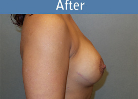 Milwaukee Plastic Surgery - Breast Reconstruction - Direct to Implant - 11-6