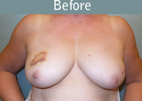 Milwaukee Plastic Surgery - Breast Reconstruction - Direct to Implant - 12-1