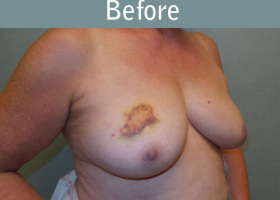 Milwaukee Plastic Surgery - Breast Reconstruction - Direct to Implant - 12-3