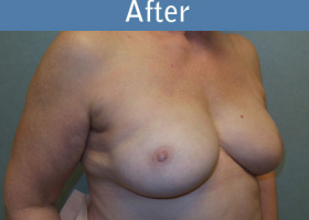 Milwaukee Plastic Surgery - Breast Reconstruction - Direct to Implant - 12-4