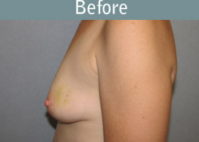Milwaukee Plastic Surgery - Breast Reconstruction - Direct to Implant - 3-1