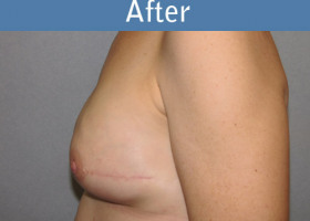 Milwaukee Plastic Surgery - Breast Reconstruction - Direct to Implant - 3-2