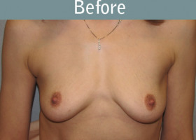 Milwaukee Plastic Surgery - Breast Reconstruction - Direct to Implant - 4-1