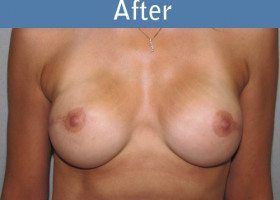 Milwaukee Plastic Surgery - Breast Reconstruction - Direct to Implant - 4-2