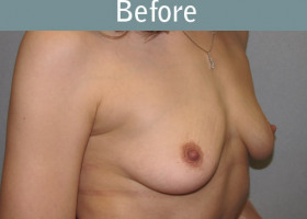 Milwaukee Plastic Surgery - Breast Reconstruction - Direct to Implant - 5-1