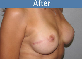 Milwaukee Plastic Surgery - Breast Reconstruction - Direct to Implant - 5-2