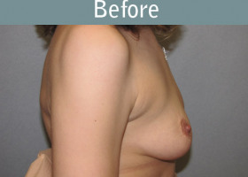 Milwaukee Plastic Surgery - Breast Reconstruction - Direct to Implant - 6-1