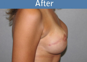 Milwaukee Plastic Surgery - Breast Reconstruction - Direct to Implant - 6-2