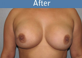 Milwaukee Plastic Surgery - Breast Reconstruction - Direct to Implant - 7-2