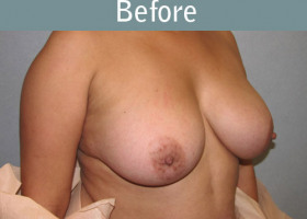 Milwaukee Plastic Surgery - Breast Reconstruction - Direct to Implant - 7-3