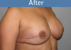 Milwaukee Plastic Surgery - Breast Reconstruction - Direct to Implant - 7-4
