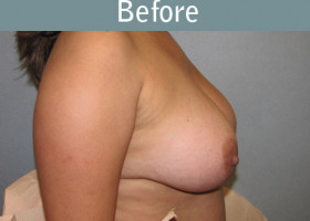 Milwaukee Plastic Surgery - Breast Reconstruction - Direct to Implant - 7-5