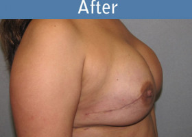 Milwaukee Plastic Surgery - Breast Reconstruction - Direct to Implant - 7-6
