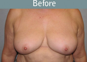 Milwaukee Plastic Surgery - Breast Reconstruction - Direct to Implant - 8-1
