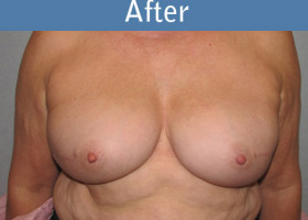Milwaukee Plastic Surgery - Breast Reconstruction - Direct to Implant - 8-2