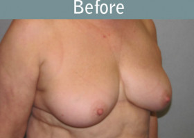 Milwaukee Plastic Surgery - Breast Reconstruction - Direct to Implant - 8-3