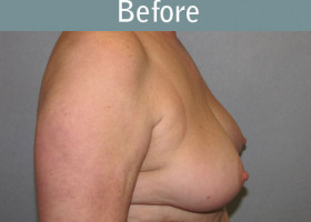 Milwaukee Plastic Surgery - Breast Reconstruction - Direct to Implant - 8-5