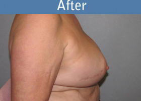 Milwaukee Plastic Surgery - Breast Reconstruction - Direct to Implant - 8-6