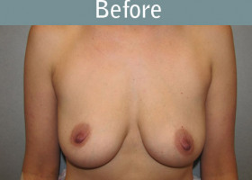 Milwaukee Plastic Surgery - Breast Reconstruction - Direct to Implant - 9-1
