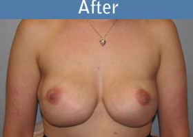 Milwaukee Plastic Surgery - Breast Reconstruction - Direct to Implant - 9-2
