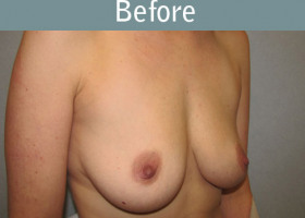 Milwaukee Plastic Surgery - Breast Reconstruction - Direct to Implant - 9-3