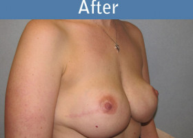 Milwaukee Plastic Surgery - Breast Reconstruction - Direct to Implant - 9-4