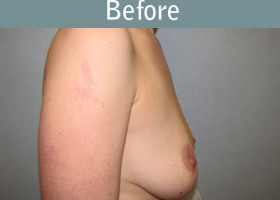 Milwaukee Plastic Surgery - Breast Reconstruction - Direct to Implant - 9-5