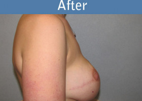 Milwaukee Plastic Surgery - Breast Reconstruction - Direct to Implant - 9-6