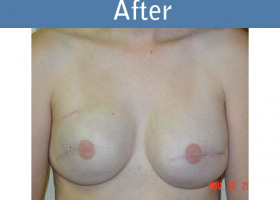 Milwaukee Plastic Surgery - Breast Reconstruction - 10-2