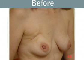 Milwaukee Plastic Surgery - Breast Reconstruction - 11-1