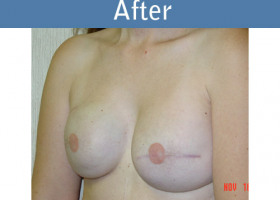Milwaukee Plastic Surgery - Breast Reconstruction - 11-2