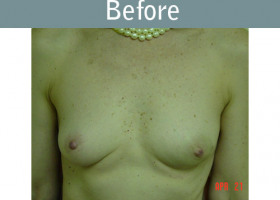 Milwaukee Plastic Surgery - Breast Reconstruction - 2-1