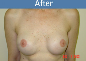 Milwaukee Plastic Surgery - Breast Reconstruction - 2-2