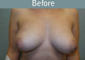 Milwaukee Plastic Surgery - Breast Reconstruction - 21-1