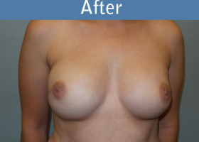 Milwaukee Plastic Surgery - Breast Reconstruction - 21-2