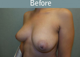 Milwaukee Plastic Surgery - Breast Reconstruction - 21-3