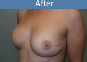 Milwaukee Plastic Surgery - Breast Reconstruction - 21-4