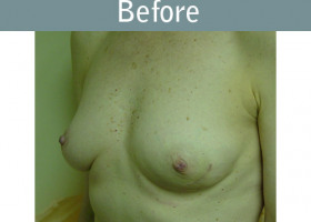 Milwaukee Plastic Surgery - Breast Reconstruction - 3-1
