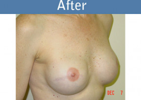 Milwaukee Plastic Surgery - Breast Reconstruction - 3-2